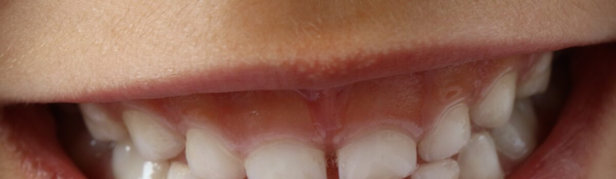 Hipersensibilidad dental se incrementa durante temporada de calor.
